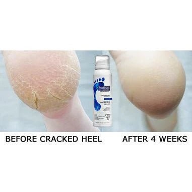 Footlogix Cracked heel formula 125ml - Voor intens herstel van gebarsten hielen - Blossoms Beauty