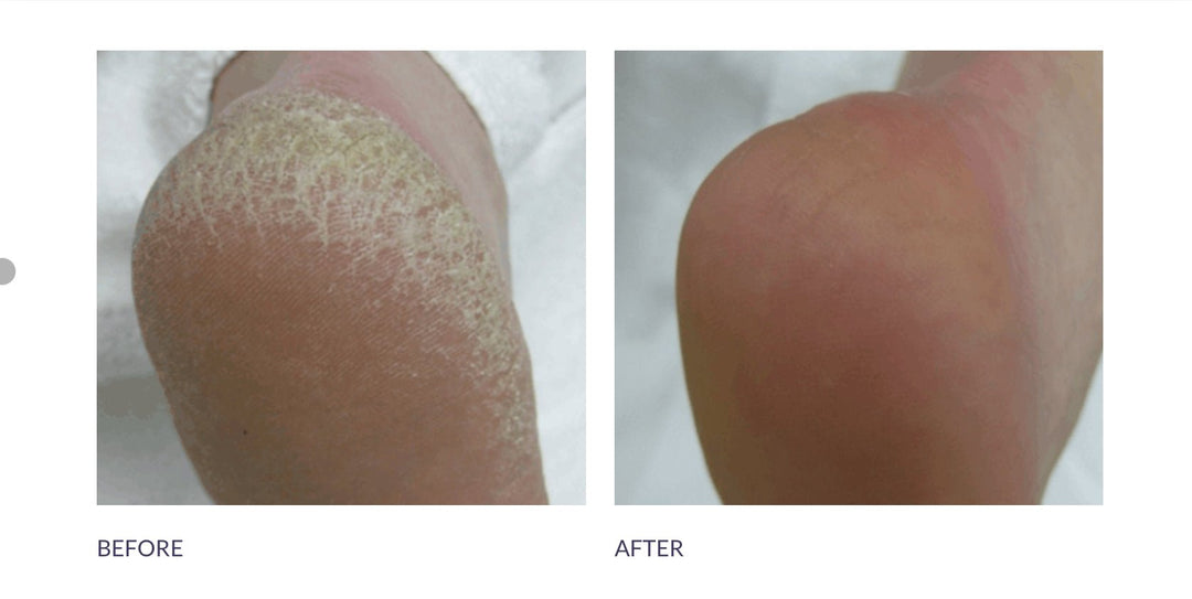 Footlogix Cracked heel formula 125ml - Voor intens herstel van gebarsten hielen - Blossoms Beauty