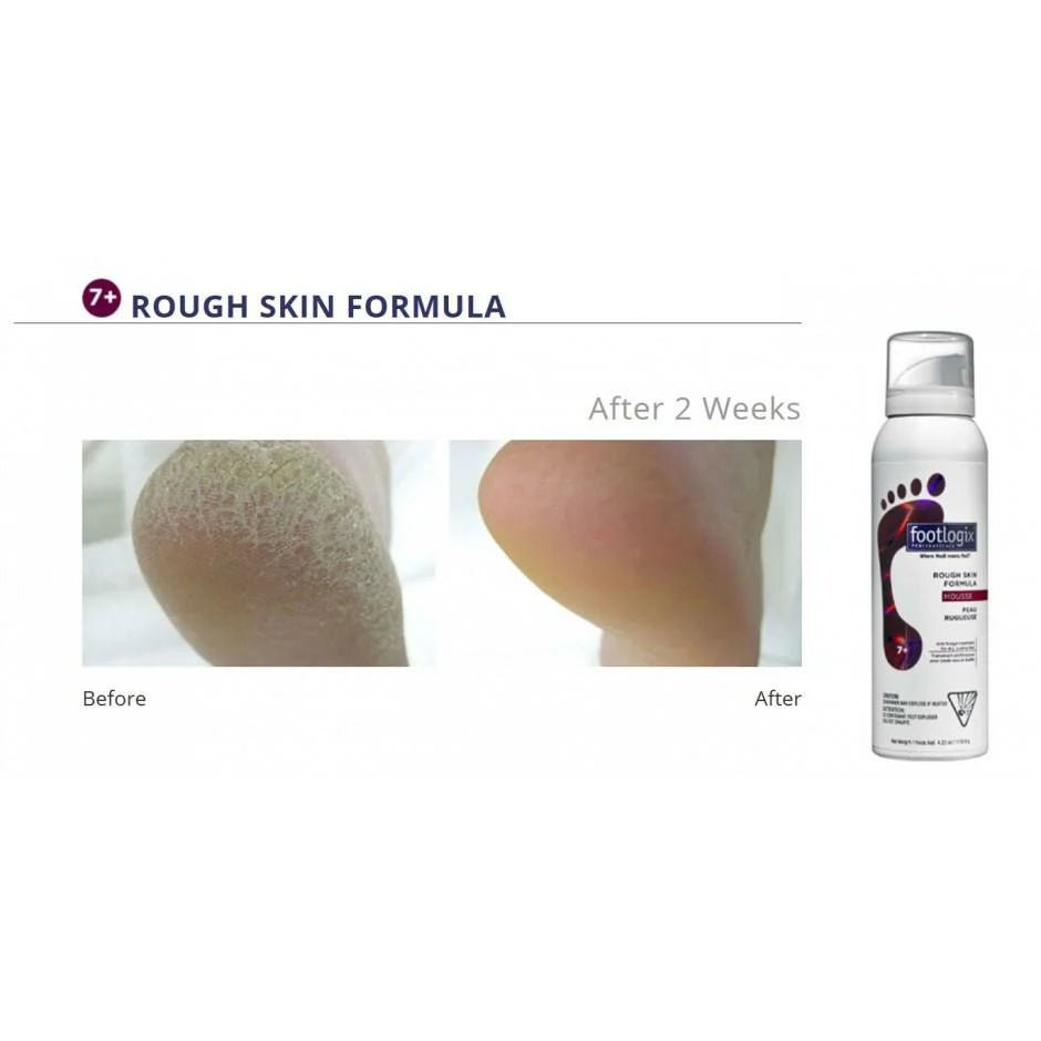 Footlogix Rough skin formula 125ml - Voor droge, ruwe of schilferige huid - Blossoms Beauty